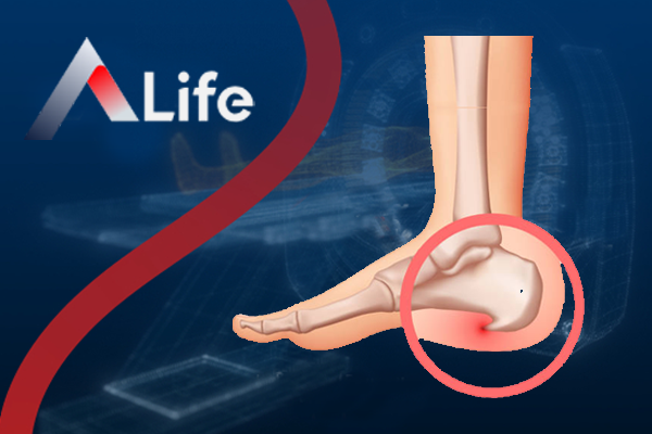 Why Heel Spurs Happen and How to Prevent Them